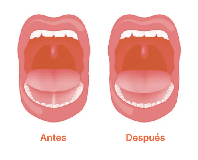 aanquiloglosia frenillo bebes